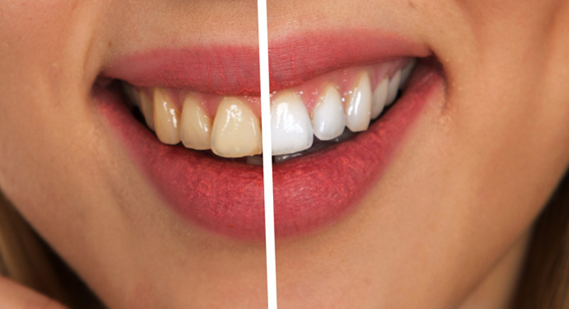 Белоснежная улыбка — мечта миллионов, однако отбеливание может привести к непоправимым последствиям