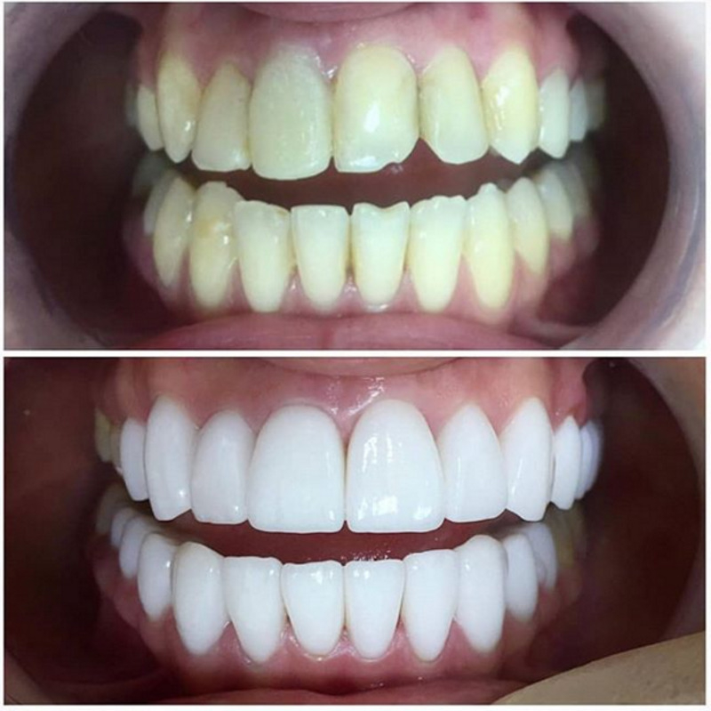 Керамические виниры способны преобразить вашу улыбку