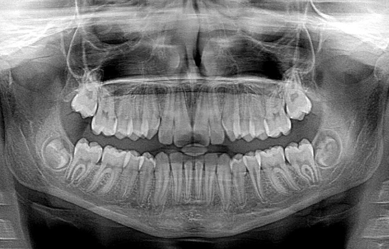 Зубы мудрости вырастают только лишь у половины населения