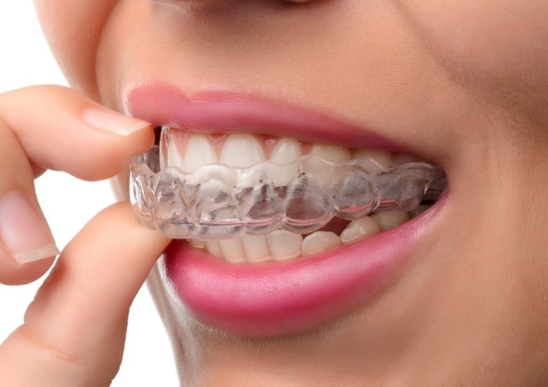 Брекеты помогут обрести красивую и здоровую улыбку