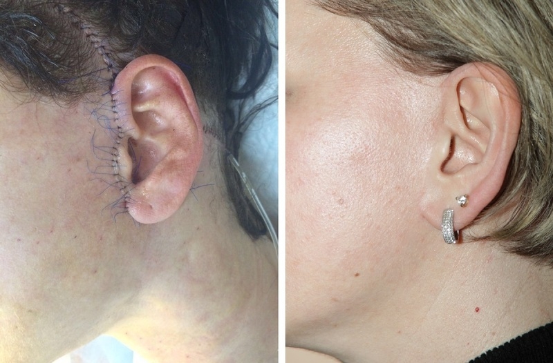 На фото: шов после SMAS подтяжки, в день операции и через 8 недель после нее.