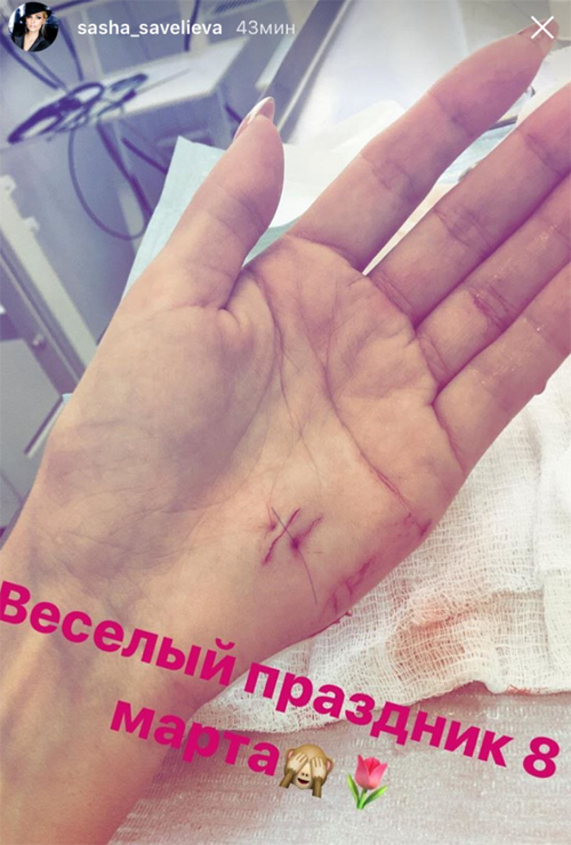 Певица сильно порезала ладонь