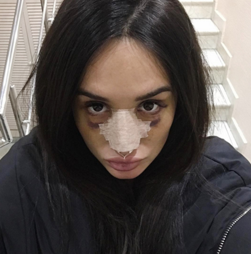 Марина Мексика никогда не скрывала, что прибегала к услугам пластических хирургов