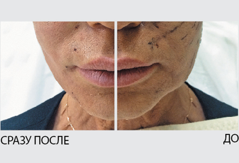 Коррекция подбородочной области
