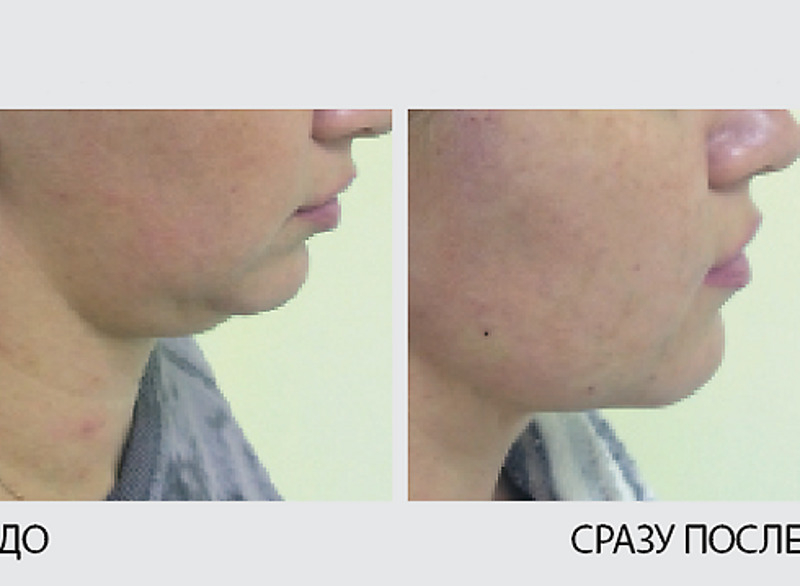 Коррекция подбородочной области