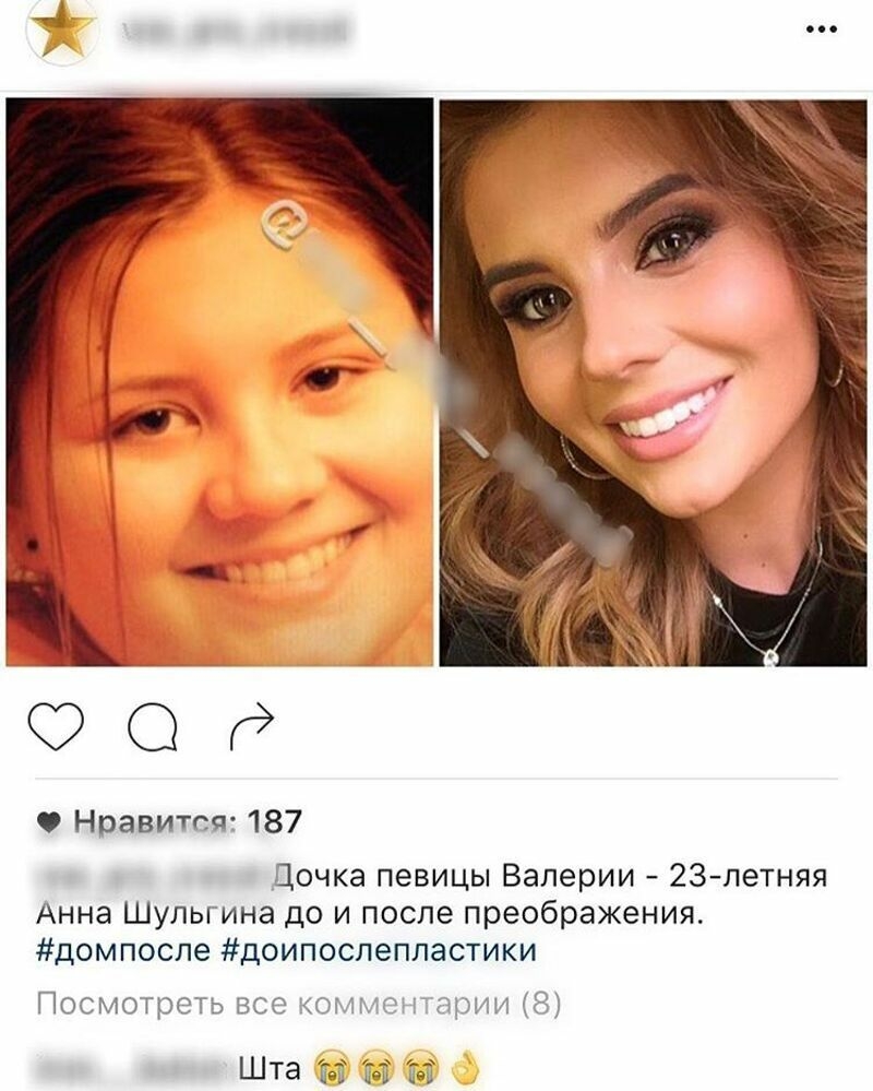Анна Шульгина опровергла вмешательства пластических хирургов в ее внешность