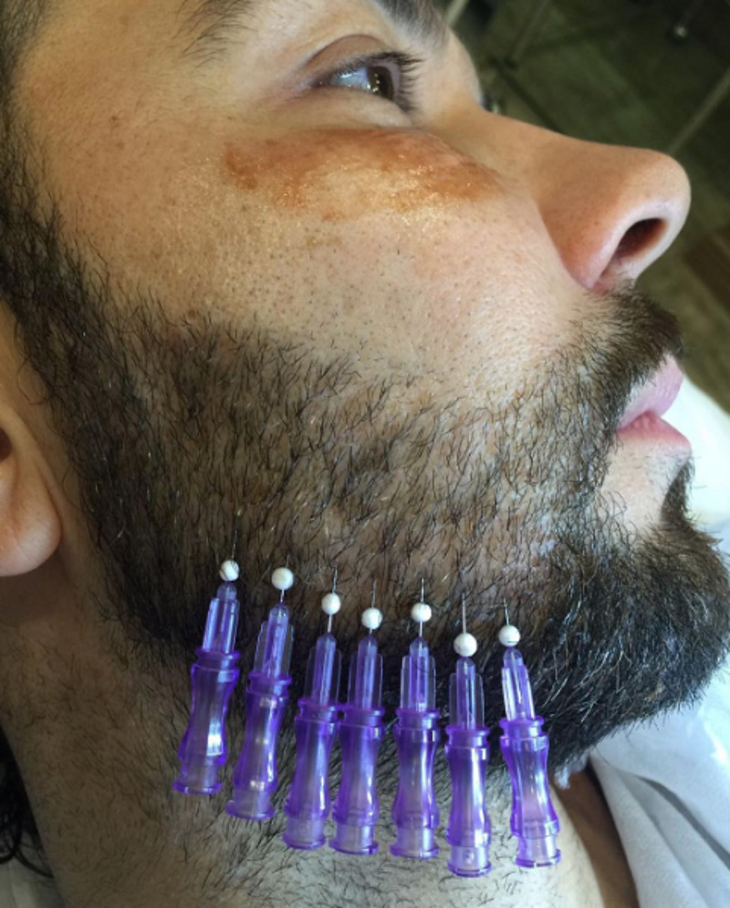 Певец терпит болезненную процедуру