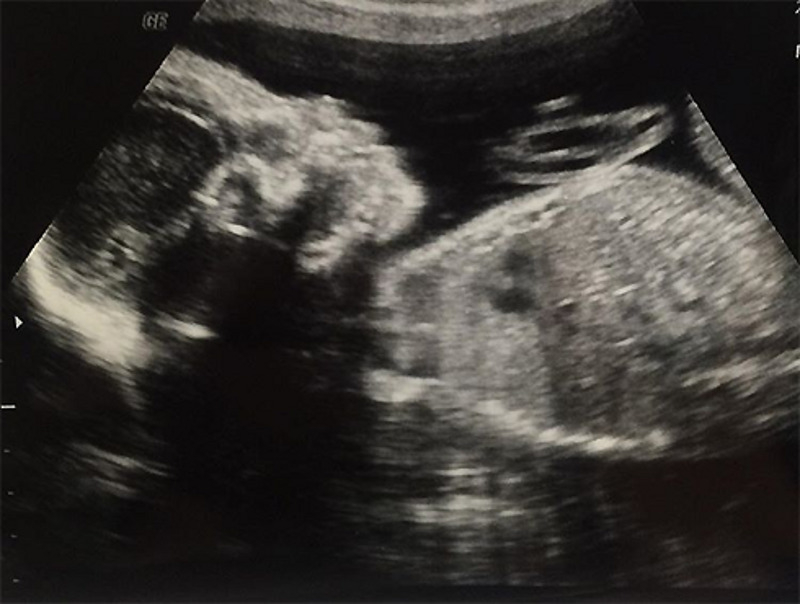 Актриса поделилась УЗИ-снимком будущего ребенка