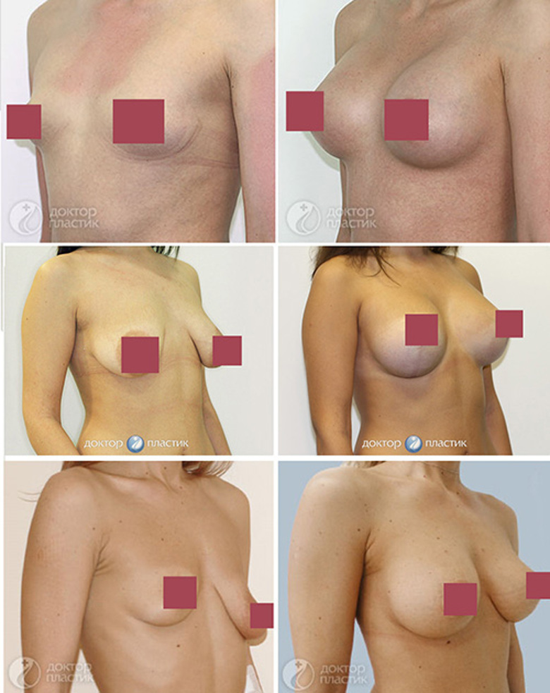 Хочешь увеличить грудь? DoctorPlastic- твой лучший выбор!