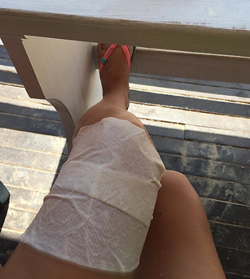 Лера лечит свою ногу специальными салфетками