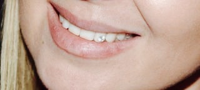 Так теперь выглядит улыбка Елены