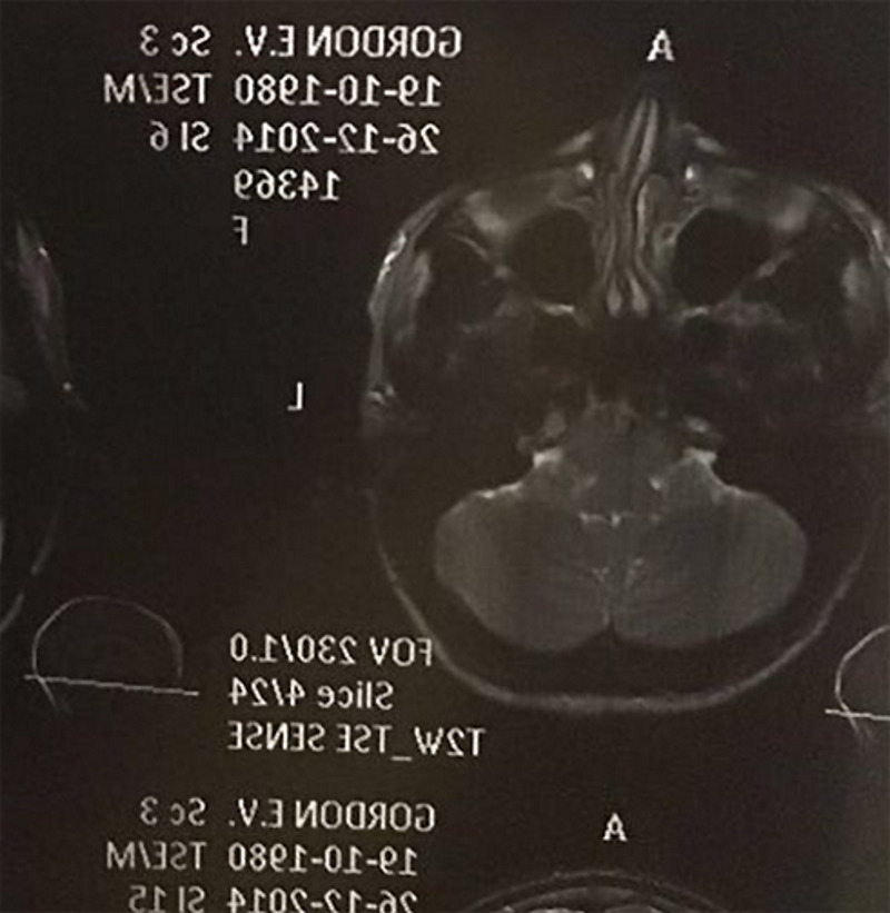 Катя Гордон сделала ринопластику