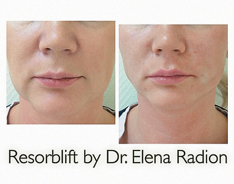 Необходимо правильно выбрать клинику и врача, которым вы доверите свое лицо.