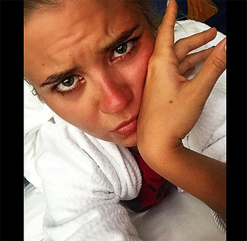 ...И в итоге получила серьезные ожоги лица. Фото: Instagram.com/anna_shulgina.