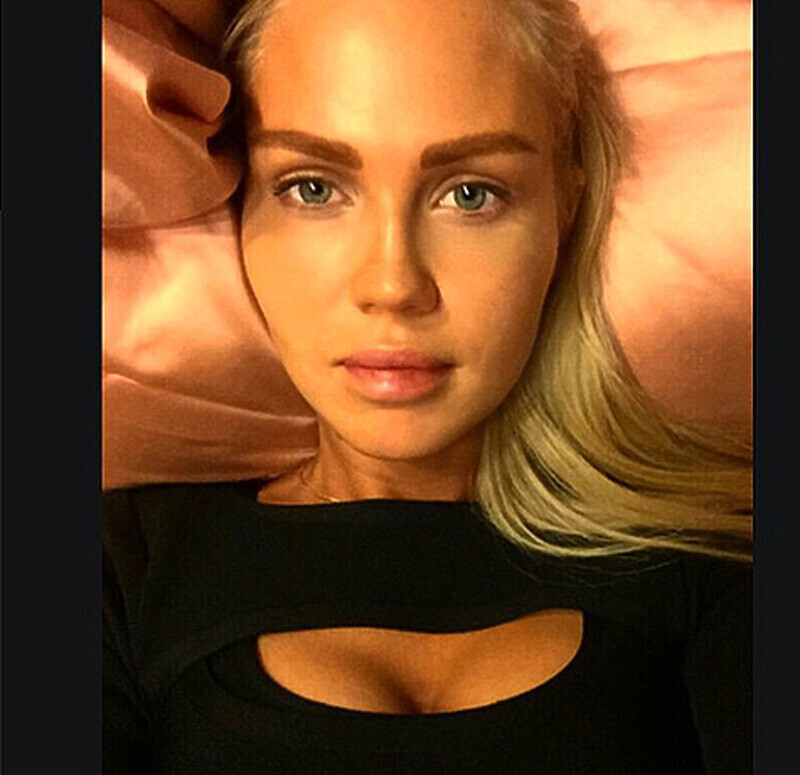 Мария Погребняк - после процедуры по удалению биогеля из губ. Фото: Instagram.com/mariapoga.