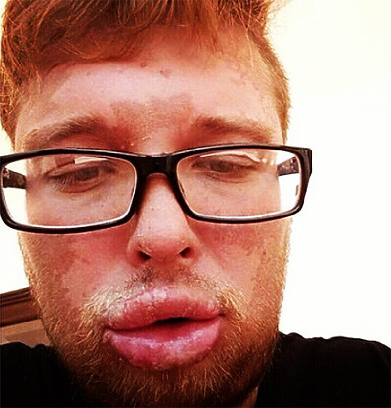 Егор Холявин получил многочисленные ожоги и был госпитализирован. Фото: Instagram.com.