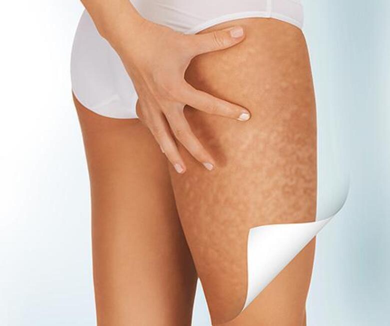 Специалисты уверены, что справиться с целлюлитом можно. Фото: Lori.ru.