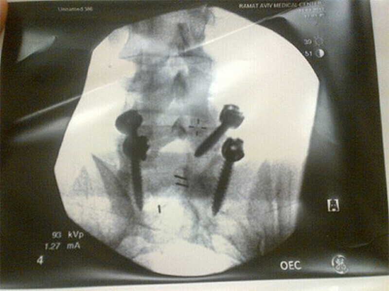 Рентген Евгения Плющенко. Фото: Twitter.com.